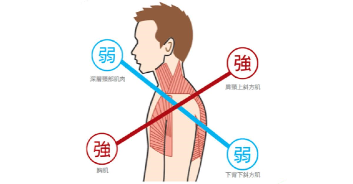 你也有駝背 圓肩的困擾嗎 簡單四招教你擺脫上交叉症候群 肌內效ex